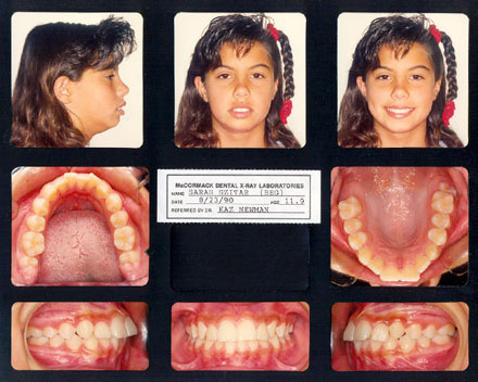 Smile Gallery Patient Before