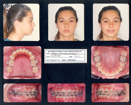 Smile Gallery Patient After