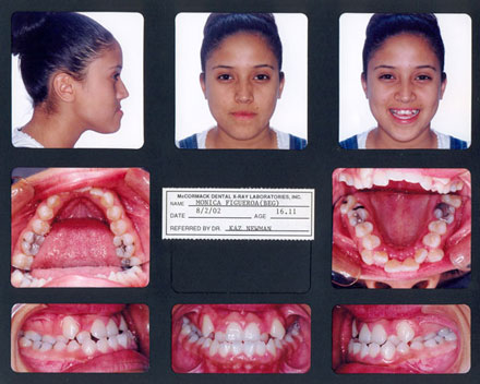 Smile Gallery Patient Before